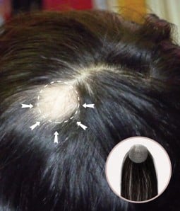 1”X 1" Full Skin Base Cover-up Hair Patches- No Surgical Solution for Alopecia Areata