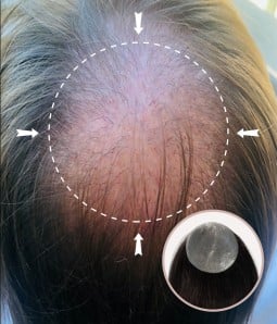 3”X 3" Full Skin Base Human Hair Cover-up Hair Patches- No Surgical Solution for Alopecia Areata |16"