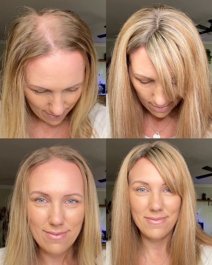 HOW TO HIDE THINNING HAIR AT THE FRONT
