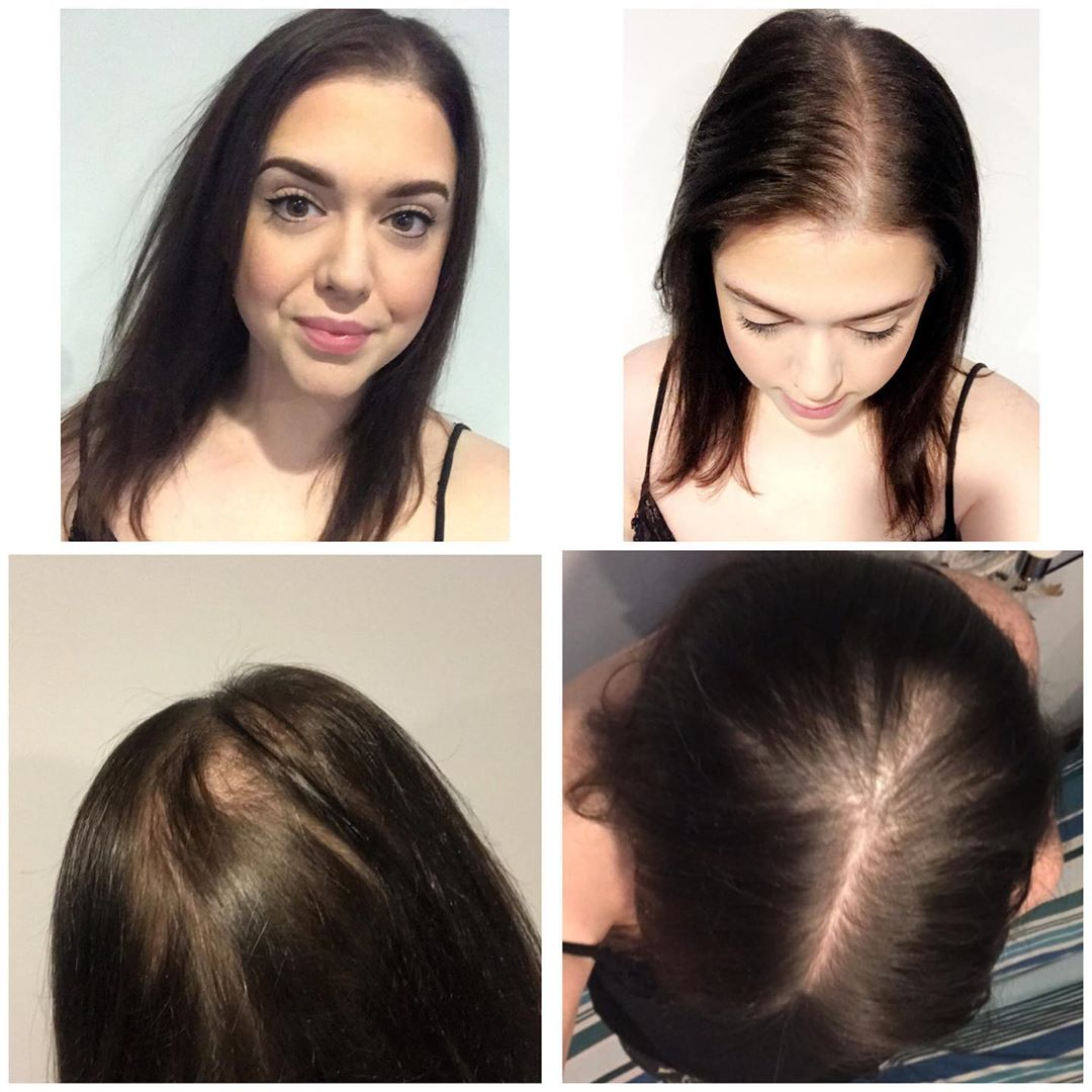 30 Haircuts for Balding Crown - Hide Bald Spots within Minutes