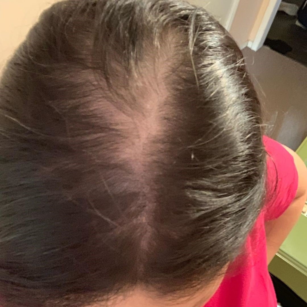 Share My Hair Loss Experience 1