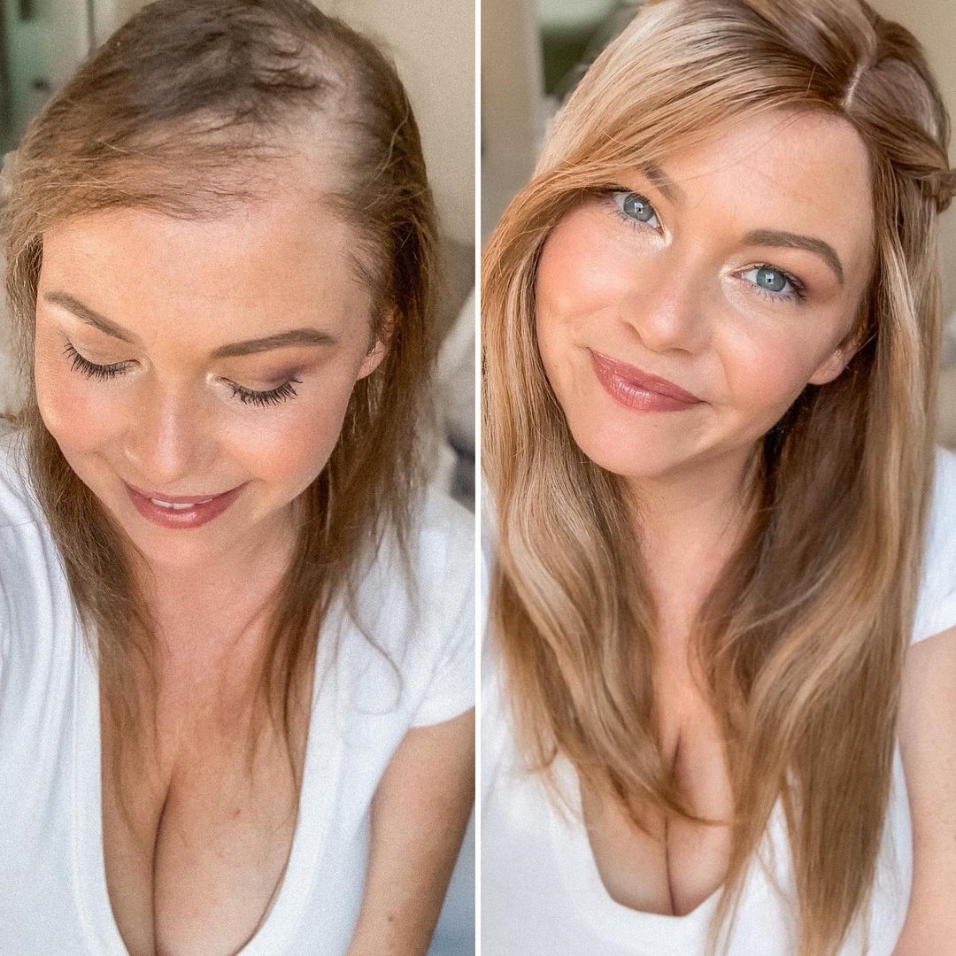 Hair Topper Before And After Hair Topper Before And After
